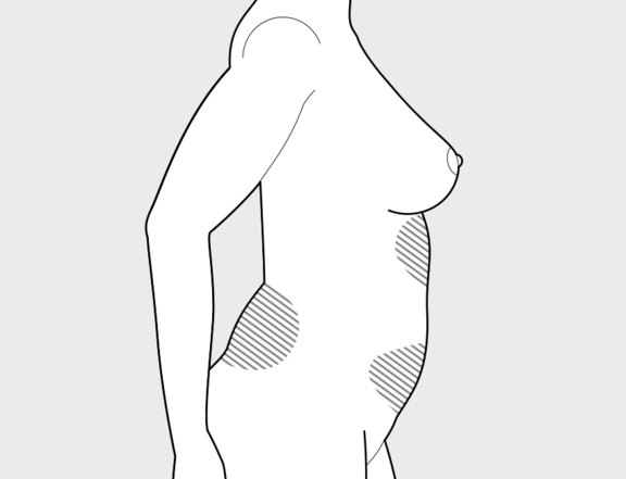 Fettabsaugung Bauch und Hüfte, Plastische Chirurgie Berlin, AesthetiCum, Dr. Ahrens, Dr. Fritzsch