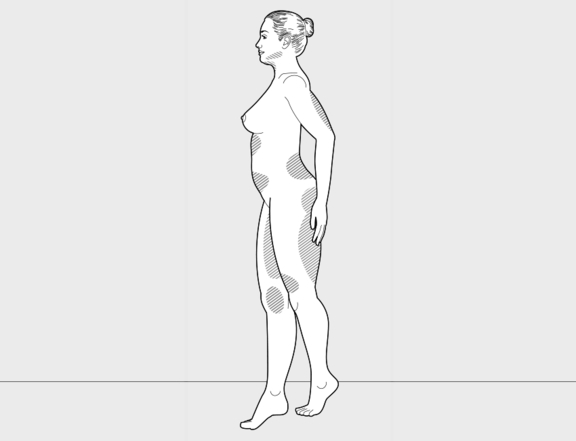 Fettabsaugung ganze Figur, Plastische Chirurgie Berlin, AesthetiCum, Dr. Ahrens, Dr. Fritzsch