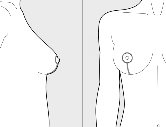 Bruststraffung, Schnittführung, Plastische Chirurgie Berlin, AesthetiCum, Dr. Ahrens, Dr. Fritzsch