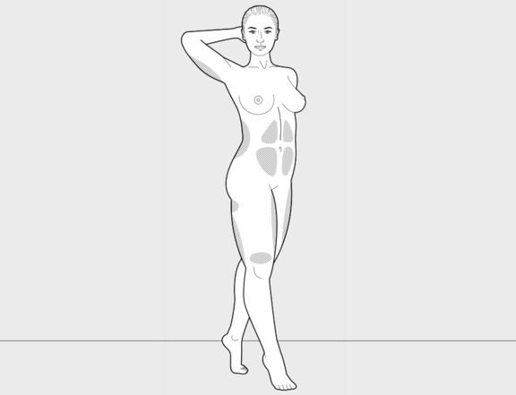 High Definition Liposuction vorher frontal, Plastische Chirurgie Berlin, AesthetiCum, Dr. Ahrens, Dr. Fritzsch