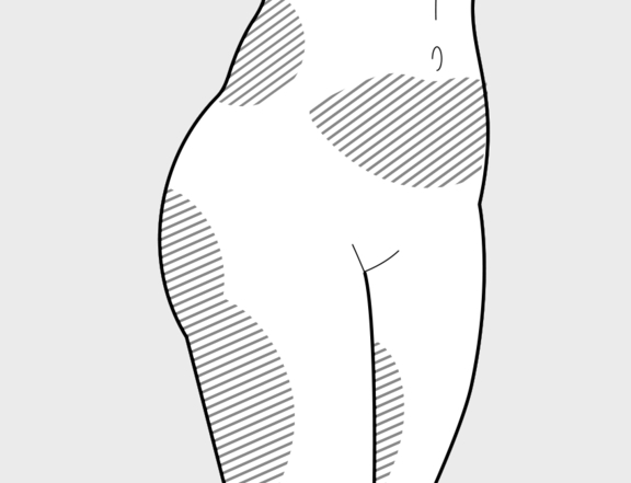 Brustvergrößerung Fettgewinnung, Zone 1, Plastische Chirurgie Berlin, AesthetiCum, Dr. Ahrens, Dr. Fritzsch