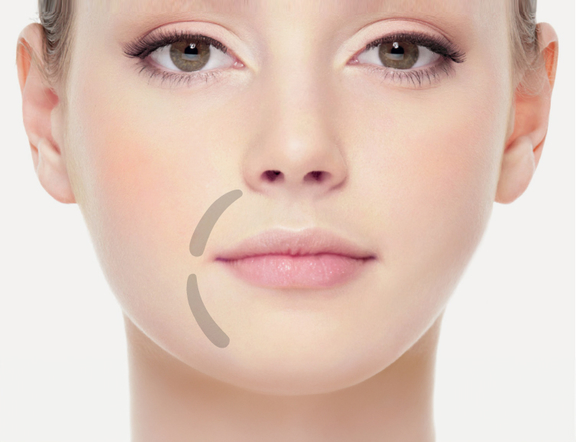 Nasolabialfalte unterspritzen, Plastische Chirurgie Berlin, AesthetiCum, Dr. Ahrens, Dr. Fritzsch