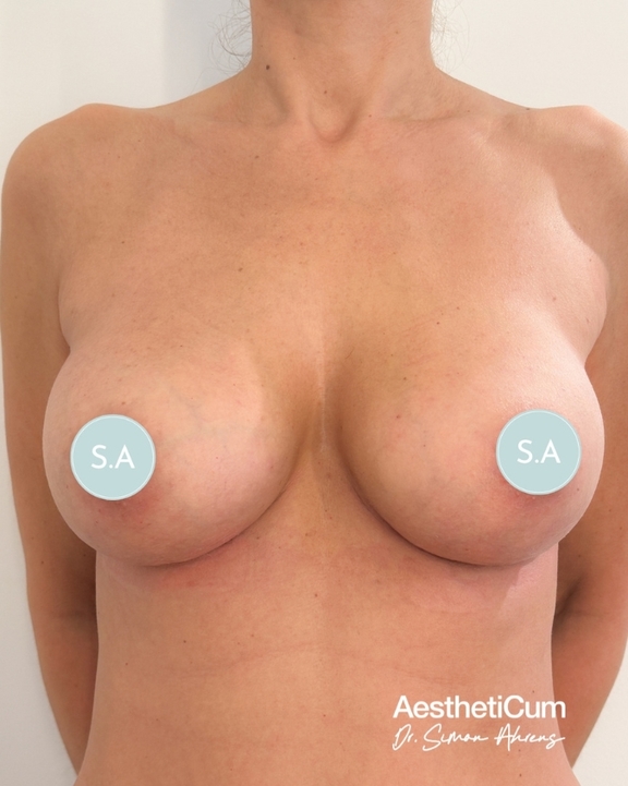aestheticum-berlin-brustvergroesserung-ergebnis11.jpg 