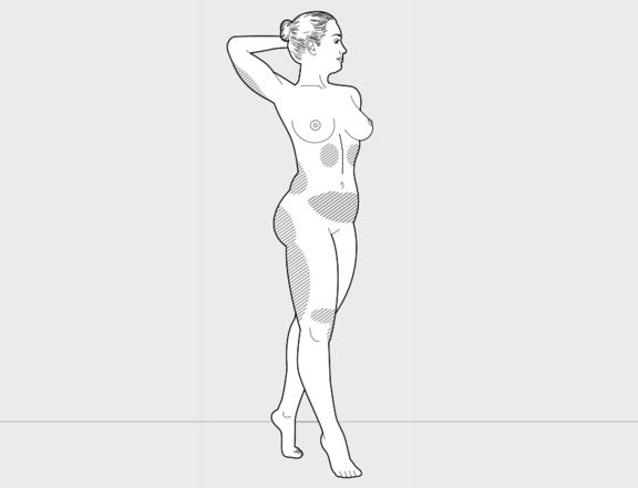 Fettabsaugung ganze Figur, Plastische Chirurgie Berlin, AesthetiCum, Dr. Ahrens, Dr. Fritzsch