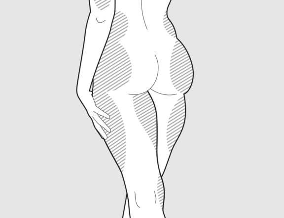 Fettabsaugung Oberschenkel und Knie, Plastische Chirurgie Berlin, AesthetiCum, Dr. Ahrens, Dr. Fritzsch