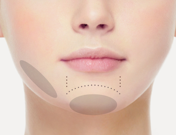 Fliehendes Kinn unterspritzen, Plastische Chirurgie Berlin, AesthetiCum, Dr. Ahrens, Dr. Fritzsch