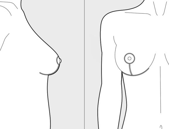 Brustverkleinerung Berlin, T-Schnitt, nachher, Plastische Chirurgie Berlin, AesthetiCum, Dr. Ahrens, Dr. Fritzsch
