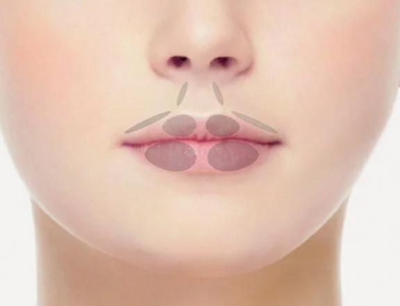 Einzeichnung Lippen aufspritzen, Plastische Chirurgie Berlin, AesthetiCum, Dr. Ahrens, Dr. Fritzsch