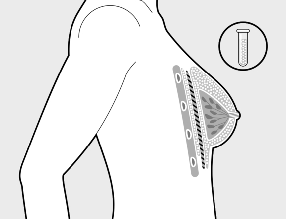 Brustvergrößerung mit Eigenfett, vorher, Plastische Chirurgie Berlin, AesthetiCum, Dr. Ahrens, Dr. Fritzsch