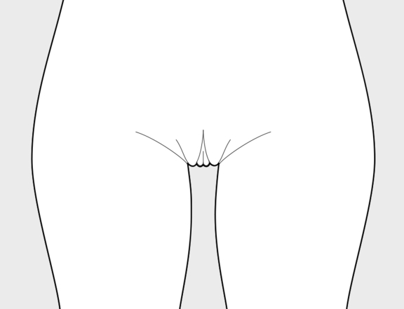 Aufpolsterung Schamlippen vorher, Plastische Chirurgie Berlin, AesthetiCum, Dr. Ahrens, Dr. Fritzsch