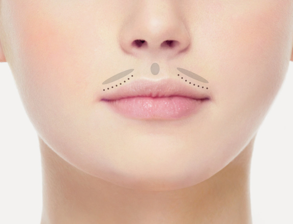 Oberlippenfalten / Raucherfältchen, Plastische Chirurgie Berlin, AesthetiCum, Dr. Ahrens, Dr. Fritzsch