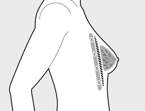 Brustvergrößerung mit Eigenfett, nachher, Plastische Chirurgie Berlin, AesthetiCum, Dr. Ahrens, Dr. Fritzsch