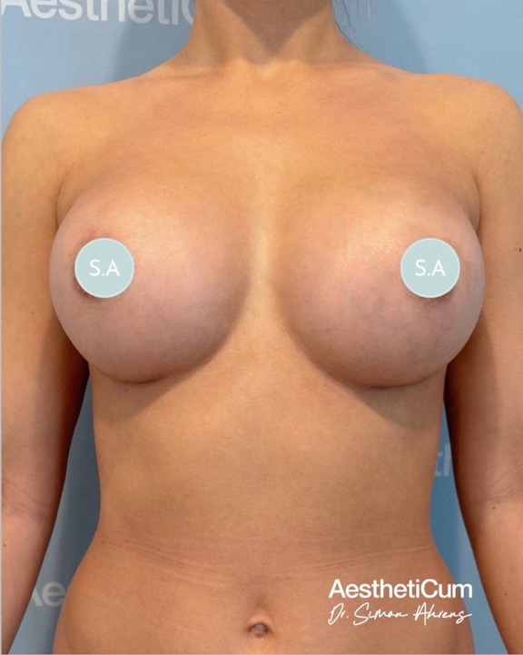 aestheticum-berlin-brustvergroesserung-ergebnis12.jpg 