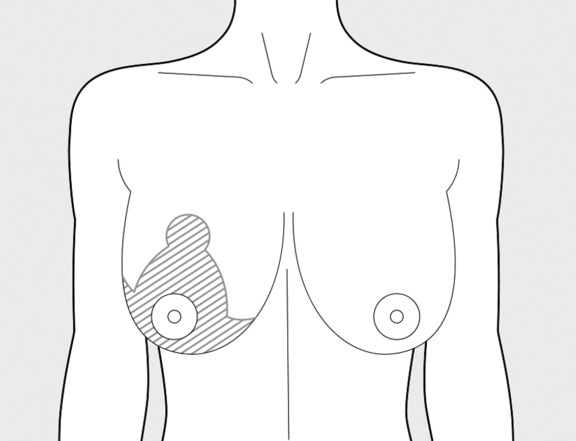Bruststraffung, vorher, Plastische Chirurgie Berlin, AesthetiCum, Dr. Ahrens, Dr. Fritzsch