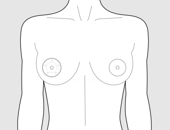 Brustwarzenhofverkleinerung, vorher, Plastische Chirurgie Berlin, AesthetiCum, Dr. Ahrens, Dr. Fritzsch