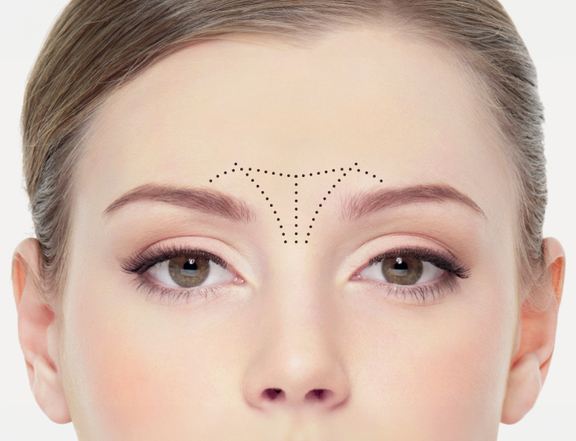 Zornesfalte, Plastische Chirurgie Berlin, AesthetiCum, Dr. Ahrens, Dr. Fritzsch