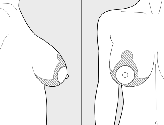 Brustverkleinerung Berlin, T-Schnitt, vorher, Plastische Chirurgie Berlin, AesthetiCum, Dr. Ahrens, Dr. Fritzsch