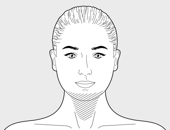 Fettabsaugung Kinn und Hals, Plastische Chirurgie Berlin, AesthetiCum, Dr. Ahrens, Dr. Fritzsch