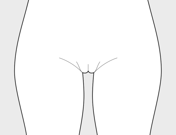 Schamlippenverkleinerung nachher, Plastische Chirurgie Berlin, AesthetiCum, Dr. Ahrens, Dr. Fritzsch