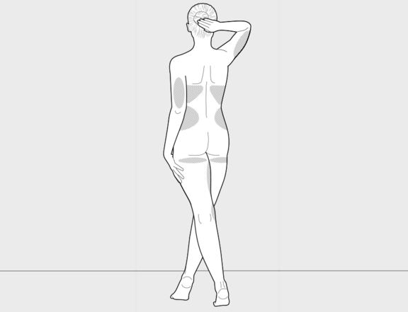 High Definition Liposuction vorher Rückenansicht, Plastische Chirurgie Berlin, AesthetiCum, Dr. Ahrens, Dr. Fritzsch