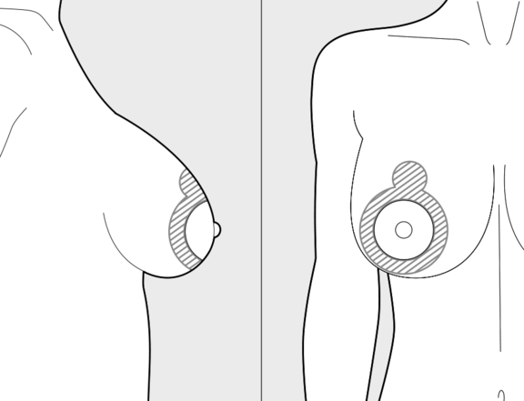 Bruststraffung, Versetzung Brustwarze, Plastische Chirurgie Berlin, AesthetiCum, Dr. Ahrens, Dr. Fritzsch