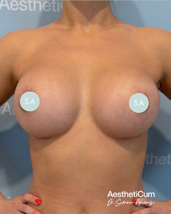 aestheticum-berlin-brustvergroesserung-ergebnis15.jpg 