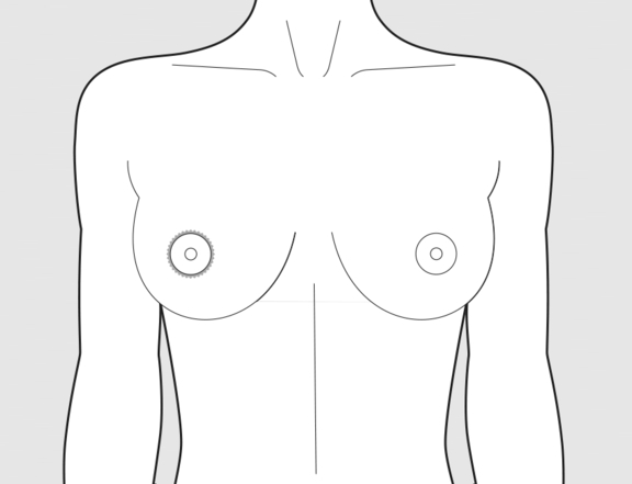 Brustwarzenhofverkleinerung, vorher, Plastische Chirurgie Berlin, AesthetiCum, Dr. Ahrens, Dr. Fritzsch
