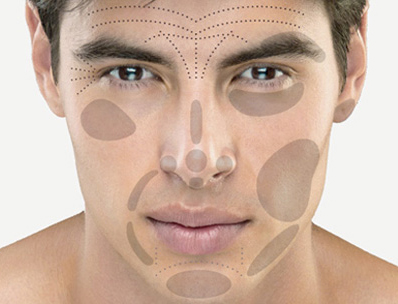 Faltenbehandlung Mann Einzeichnungen, Plastische Chirurgie Berlin, AesthetiCum, Dr. Ahrens, Dr. Fritzsch